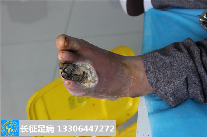 糖尿病足截肢