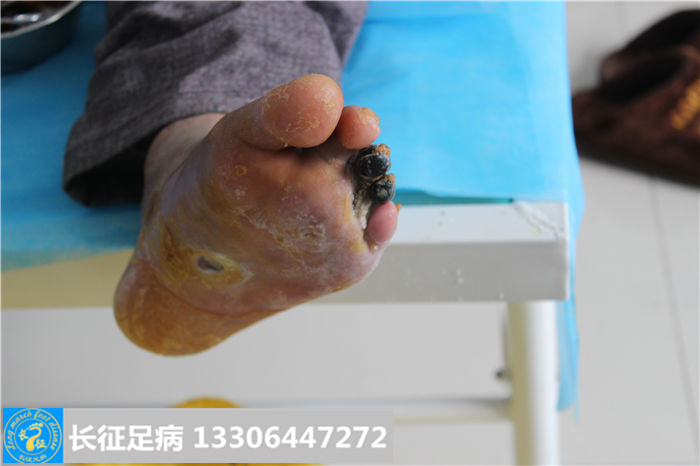 糖尿病足截肢