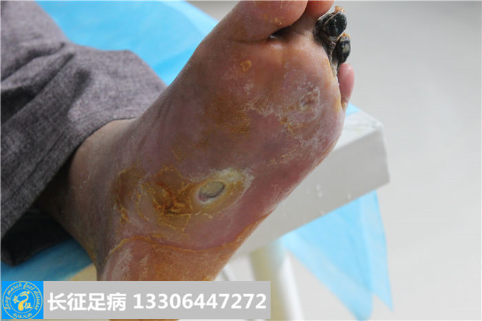 糖尿病足截肢
