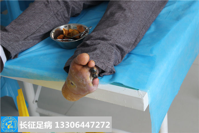 糖尿病足截肢