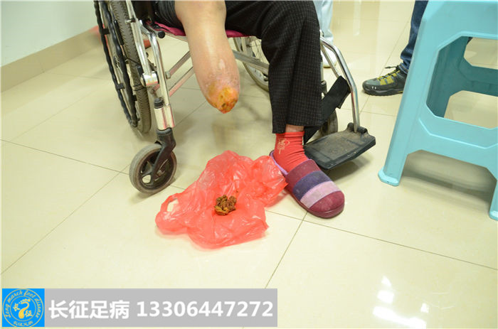 糖尿病足坏疽