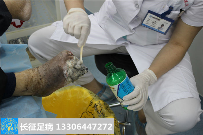 糖尿病足坏疽