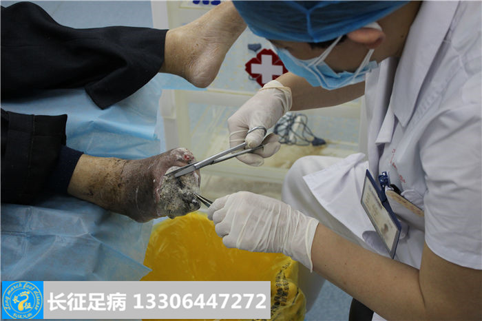 糖尿病足坏疽