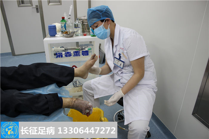 糖尿病足坏疽