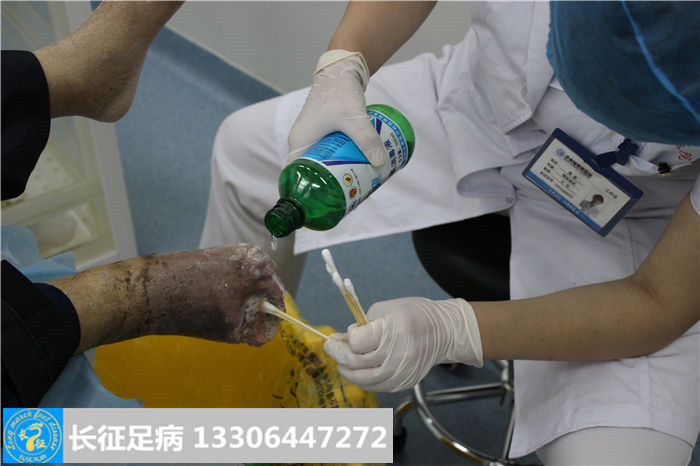 糖尿病足坏疽