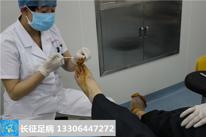 糖尿病足坏疽