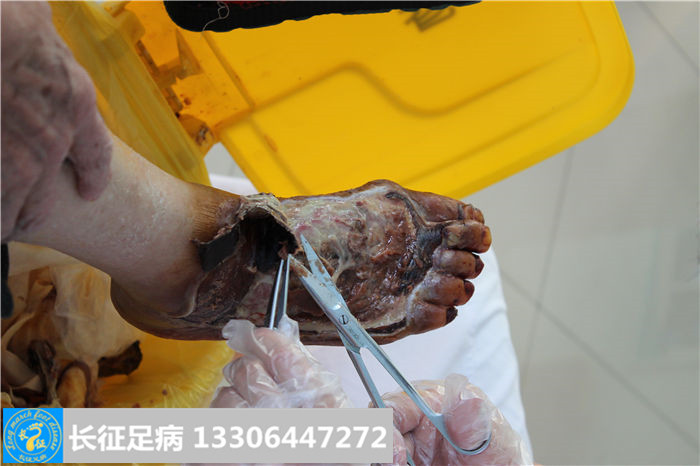糖尿病足坏疽