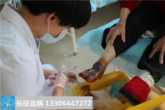 糖尿病足怎么治疗