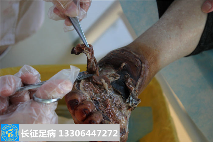 糖尿病足怎么治疗