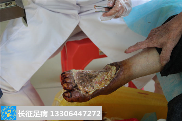 糖尿病足怎么治疗