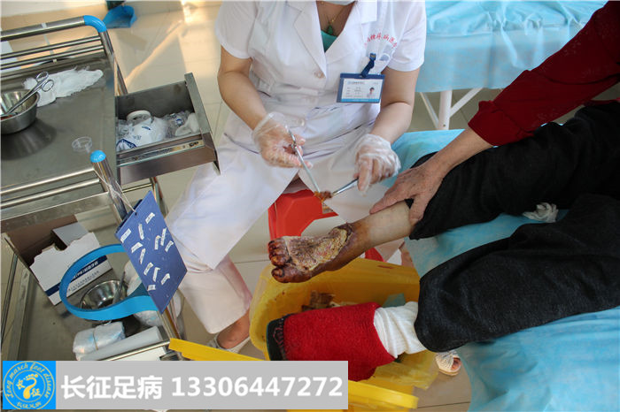 糖尿病足怎么治疗